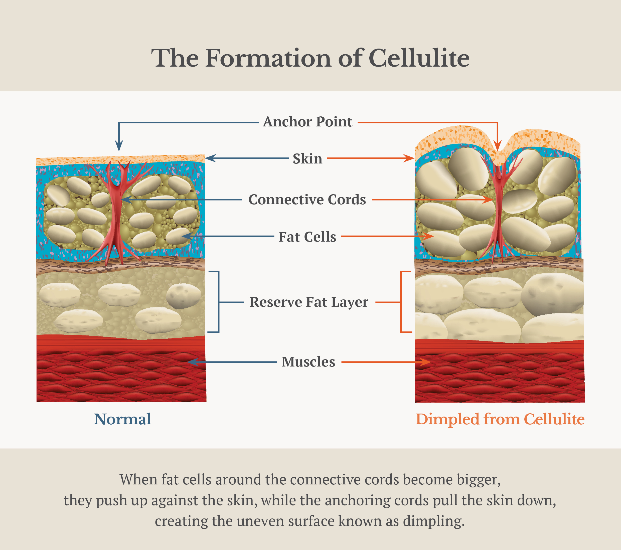 Formation of Cellulite